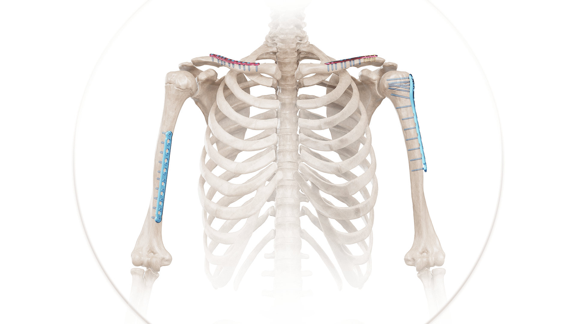 Klavikula Anatomik Plak