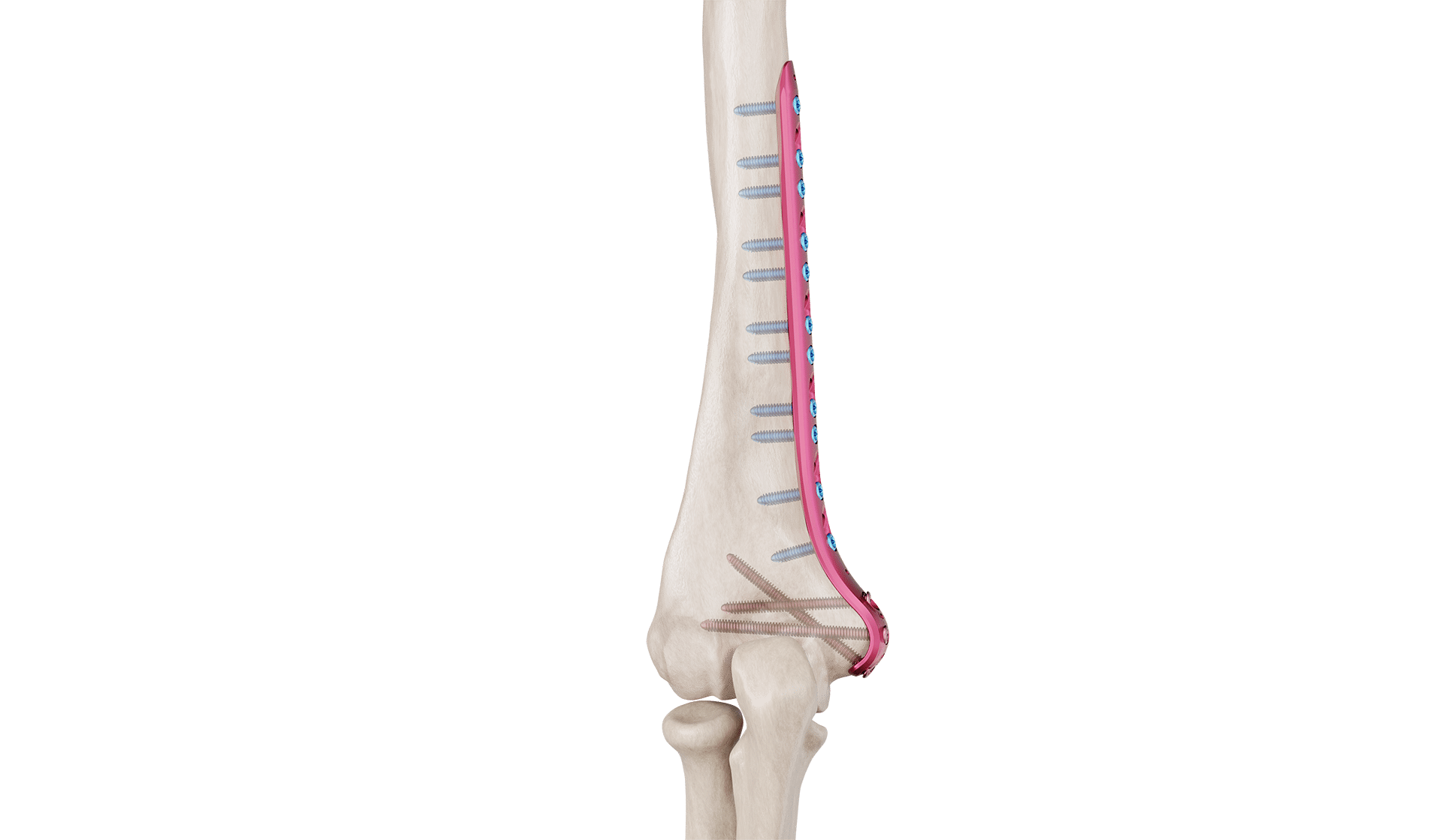 Distal Humerus Medyal Plak