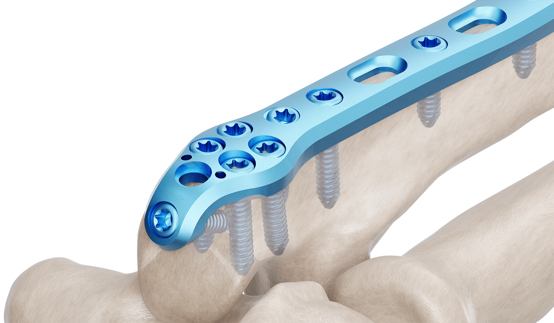 Olecranon Anatomik Plak
