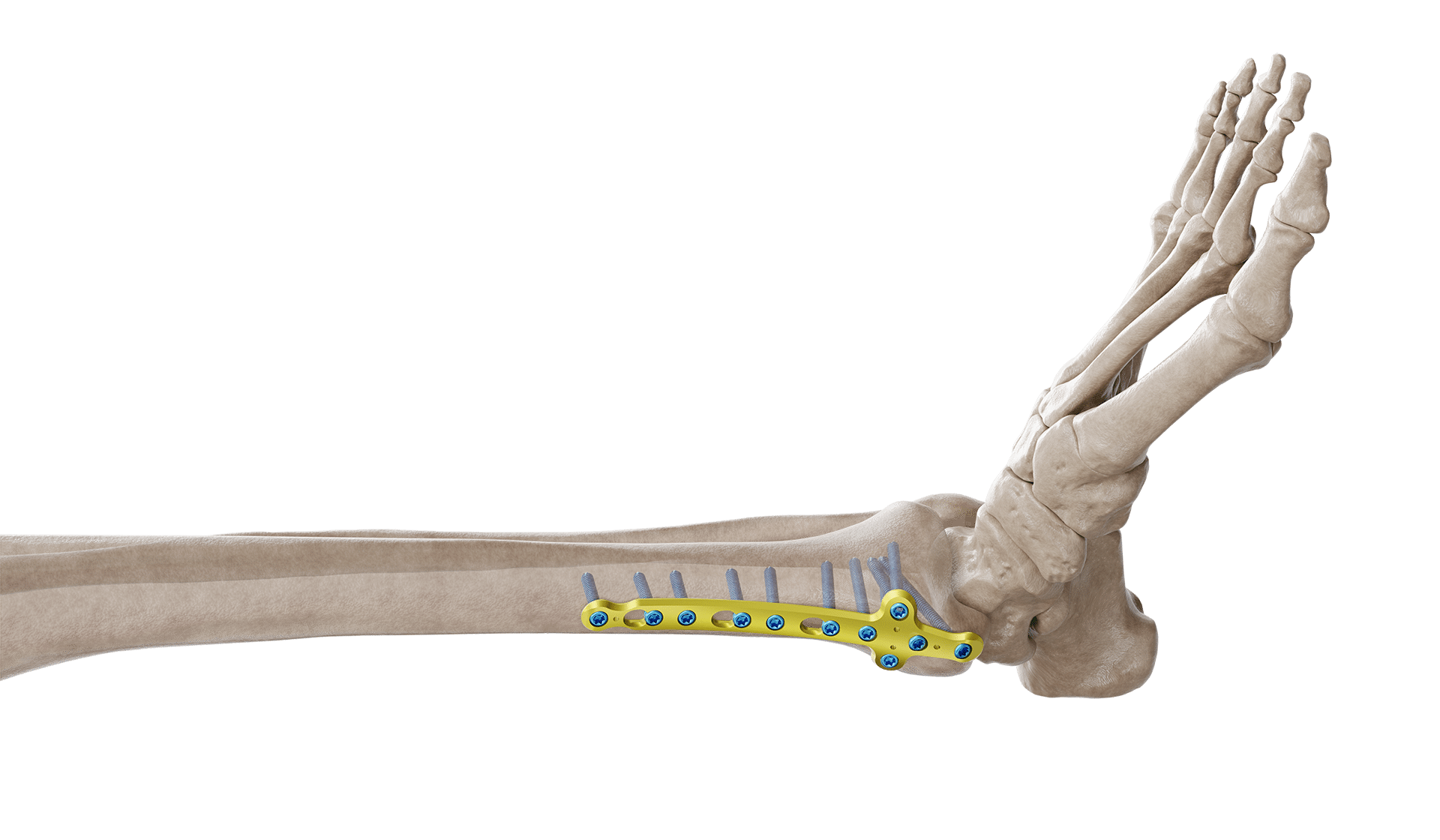 Distal Tibia Medyal Malleolar Plak
