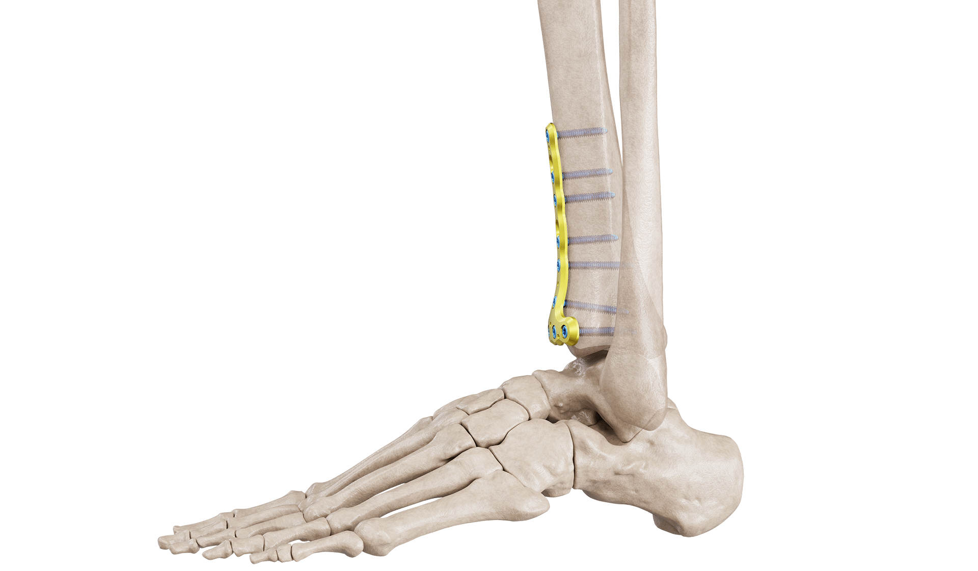 Distal Tibia Anterior Plak