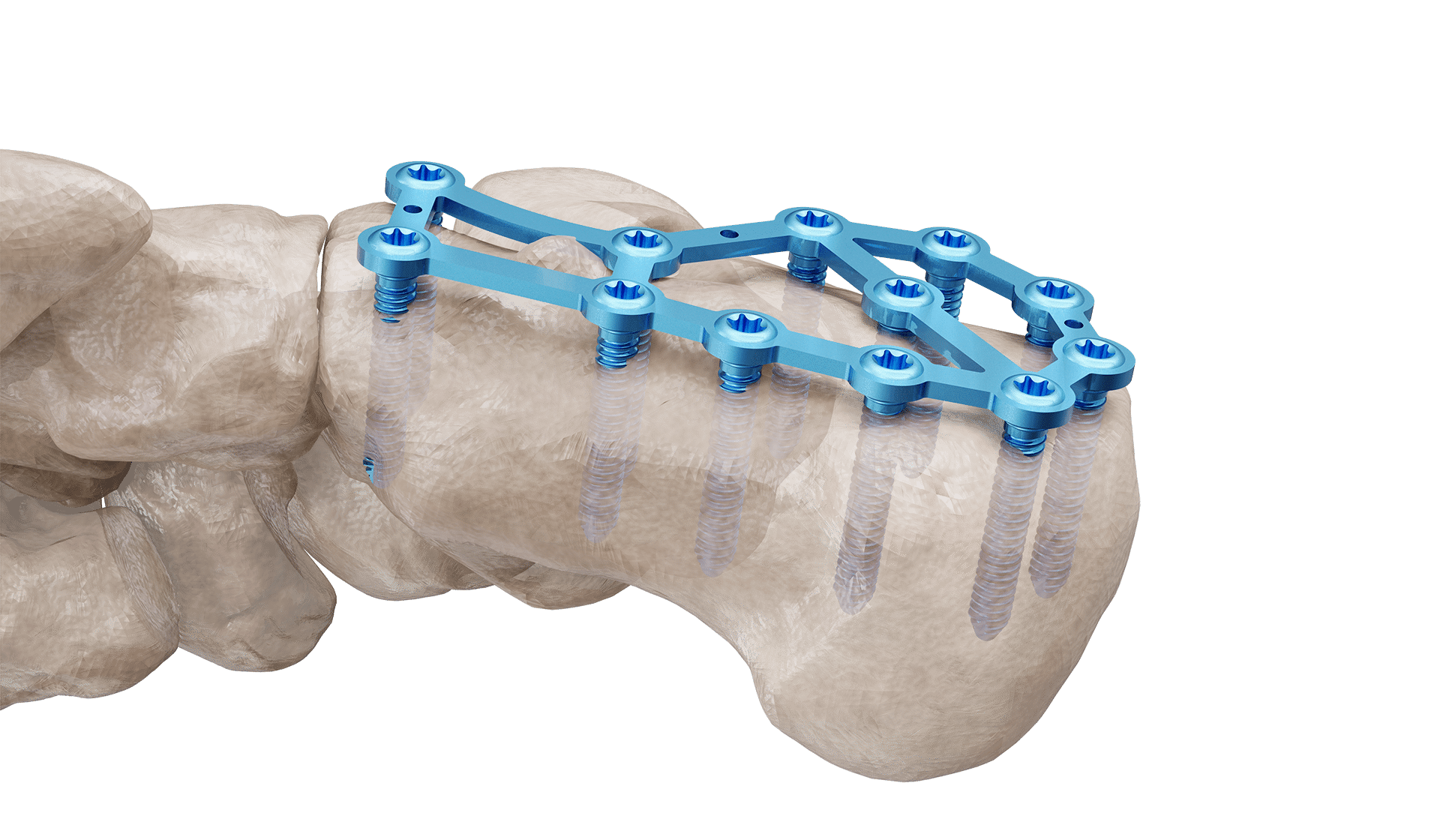 Calcaneus Plak