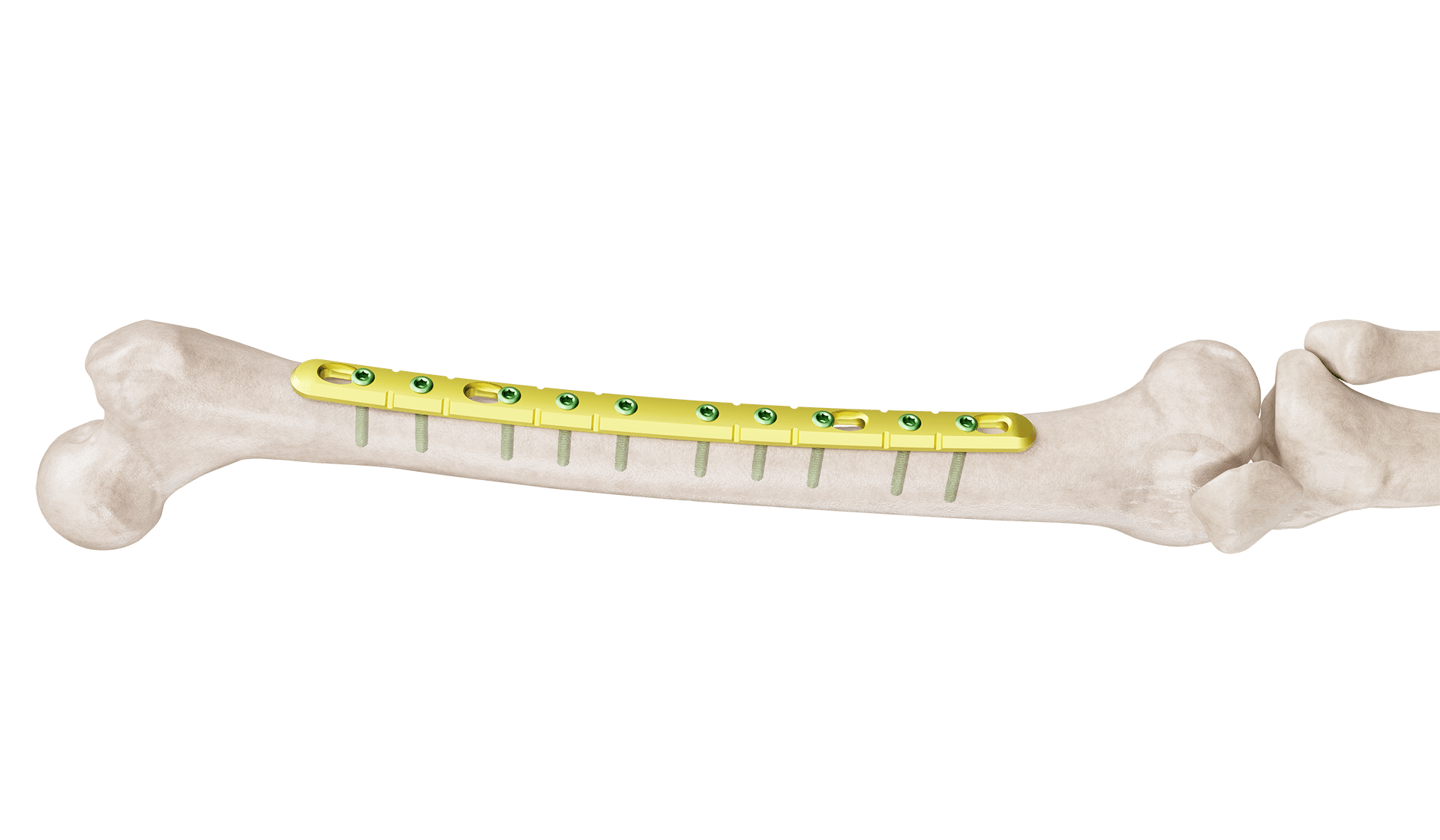 4.5 mm Femur Broad Düz Plak