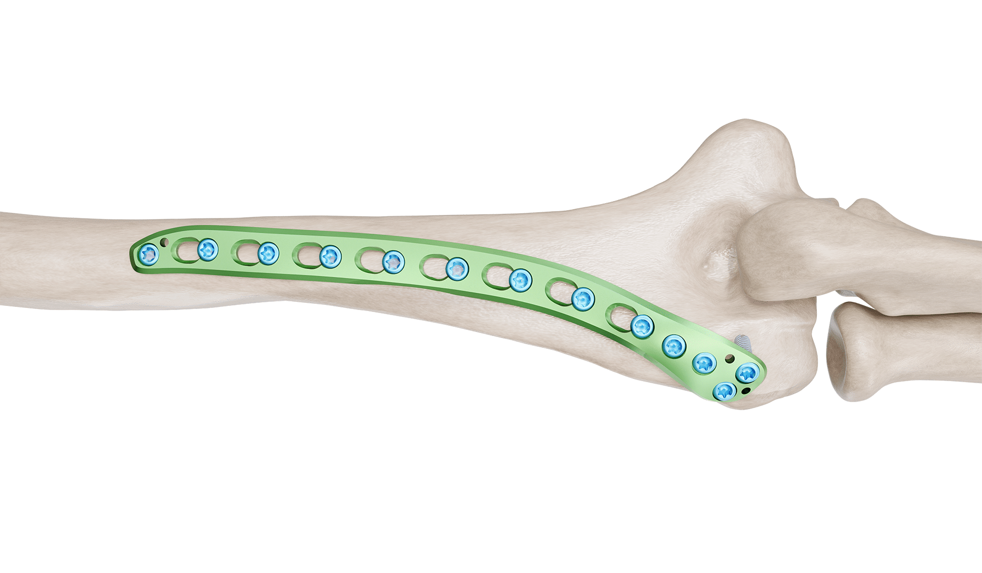 Distal Humerus Posterolateral Plak