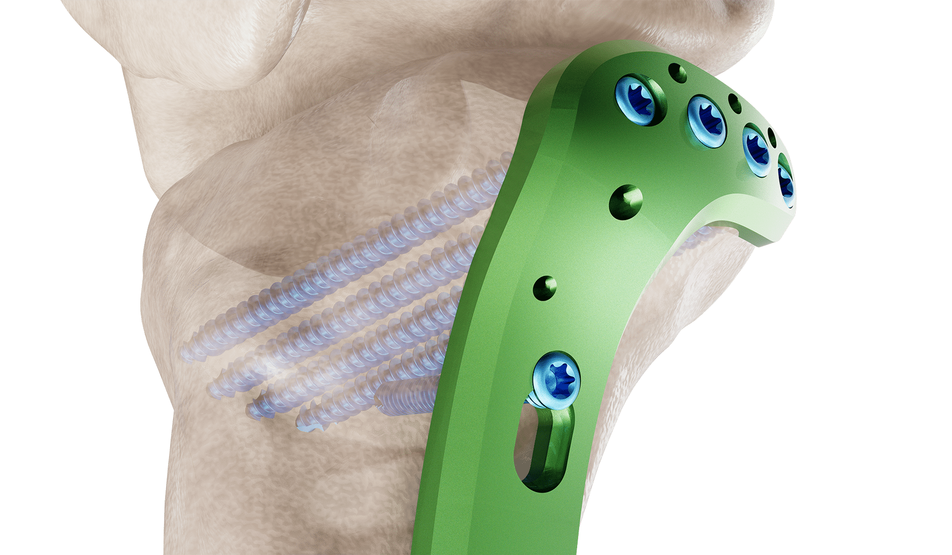 Proksimal Tibia Lateral Anatomik Plak