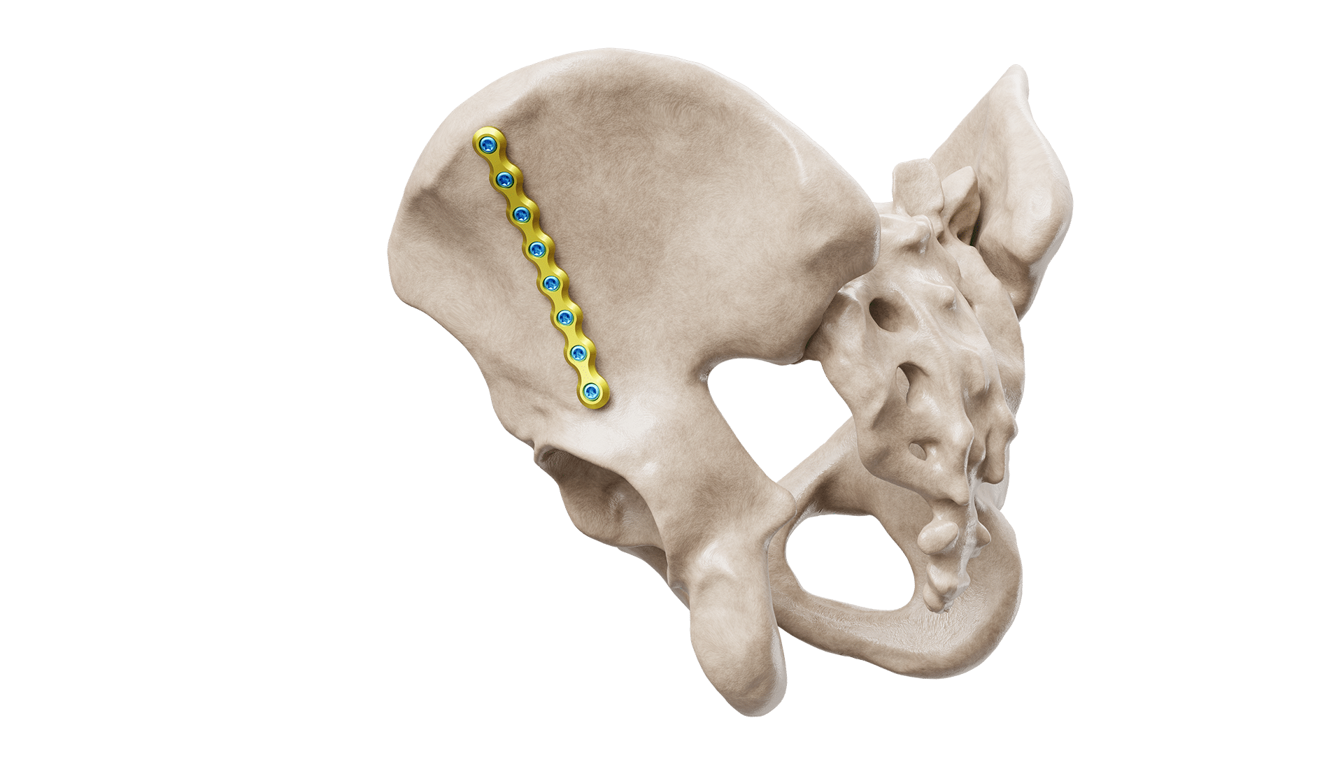 Pelvis Rekonstrüksiyon Düz Plak