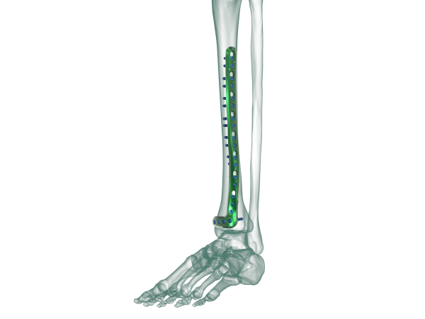 Distal Medial Tibia Locking Plate, Size: 4.5mm /3.5mm